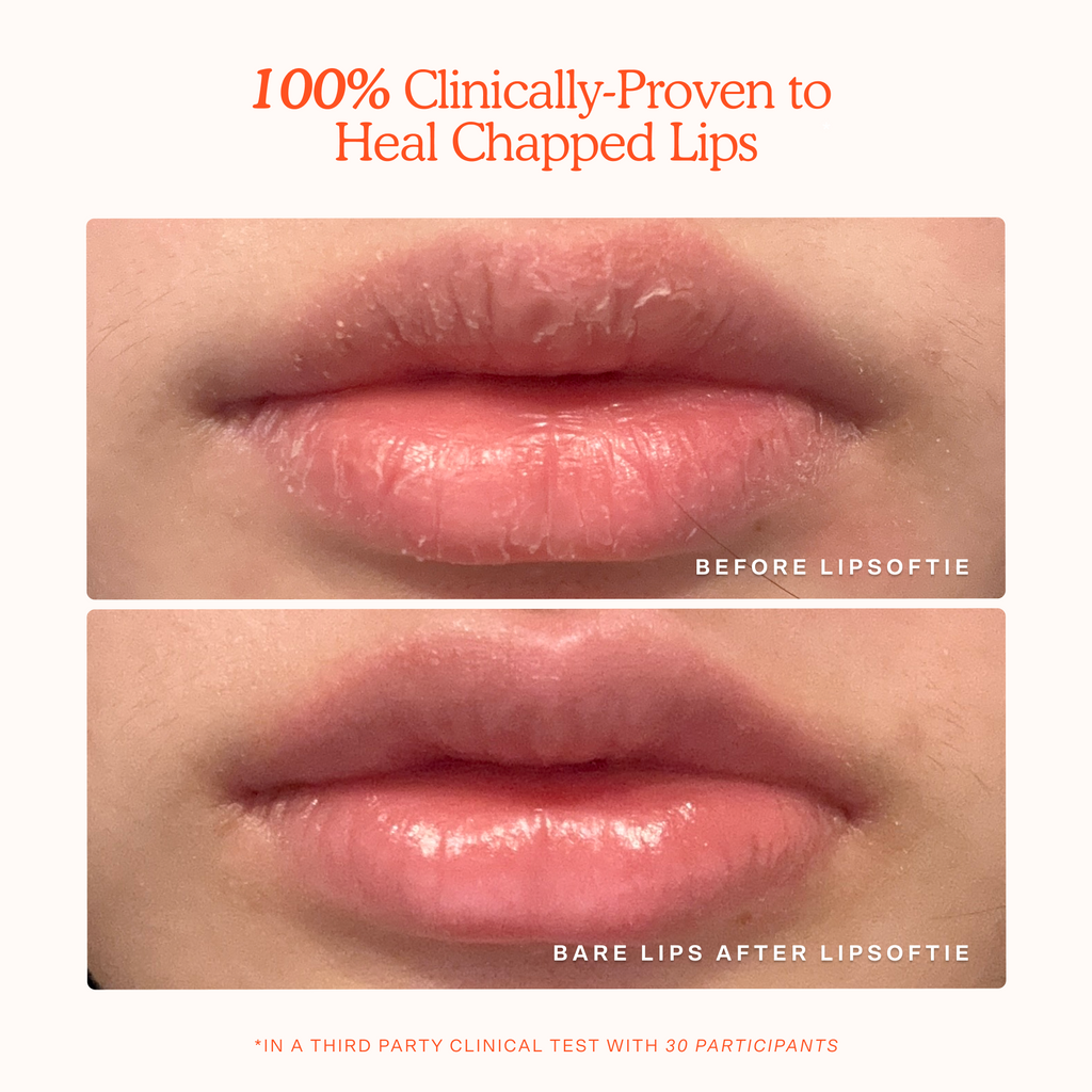 LipSoftie® Lip Treatment Q0