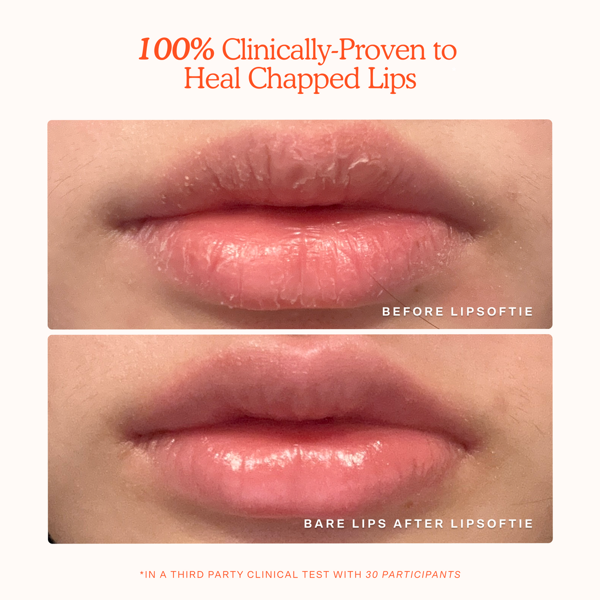 LipSoftie® Lip Treatment Q0