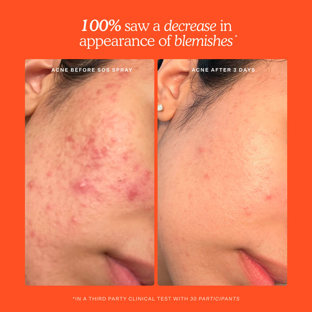 SOS 3-Step Skincare Set V9