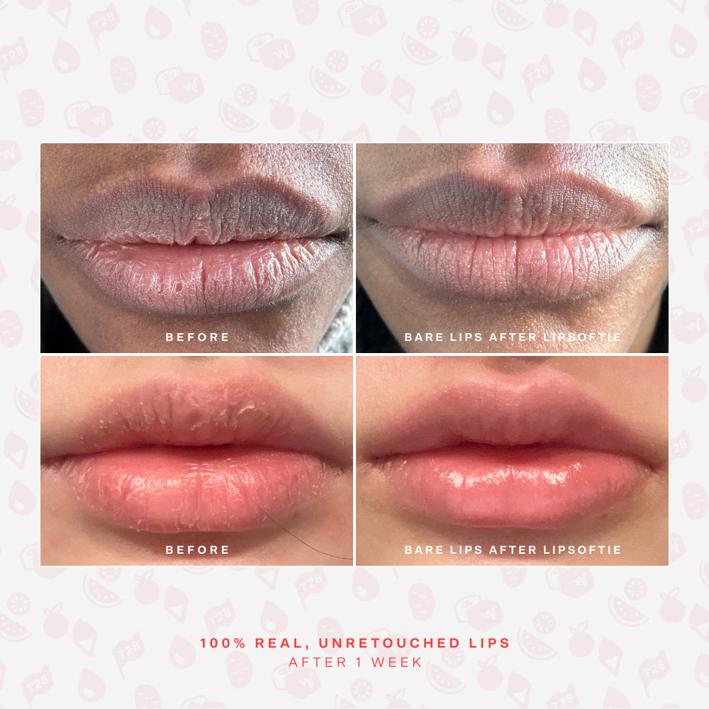 SOS LipSoftie® Lip Treatment D2