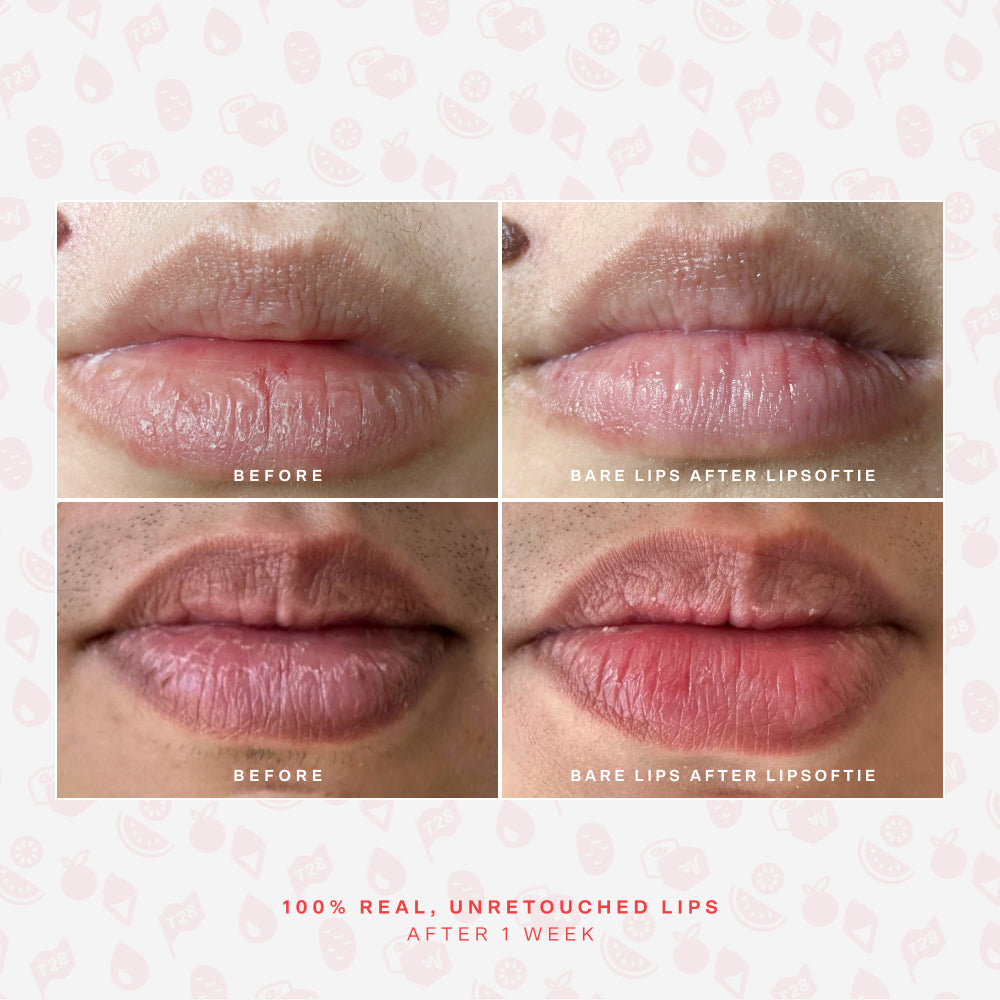 SOS LipSoftie® Lip Treatment D2