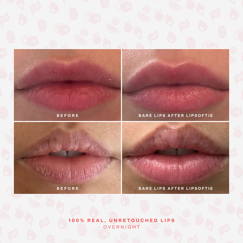 SOS LipSoftie® Lip Treatment O3